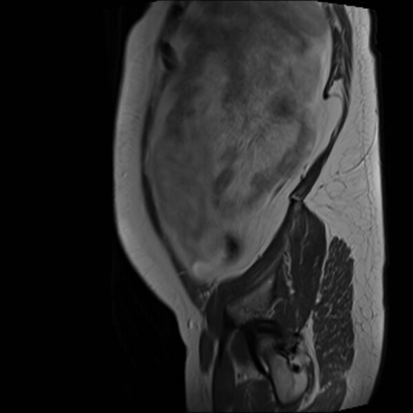 File:Bilobed placenta accreta (Radiopaedia 69648-79591 Sagittal T2 3).jpg