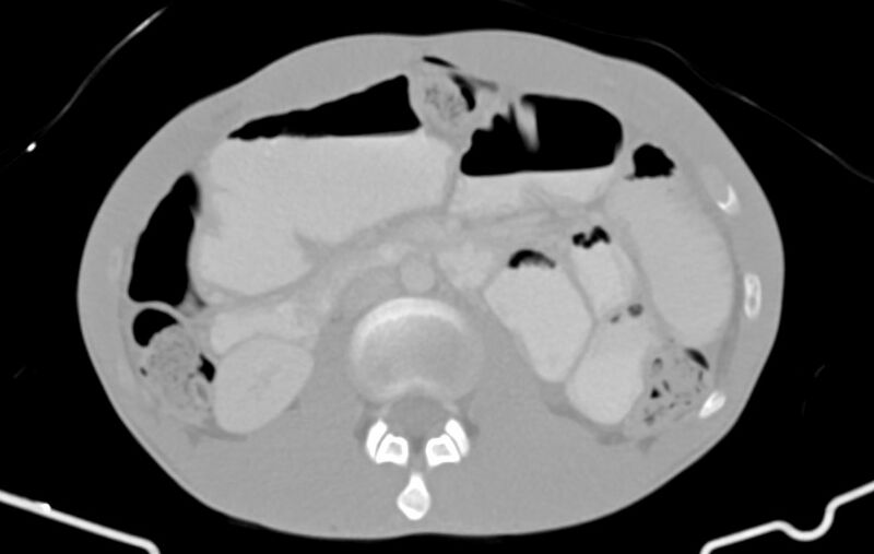 File:Blunt injury to the small bowel (Radiopaedia 74953-85987 Axial Wide 37).jpg