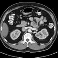 Bosniak cyst - type IV (Radiopaedia 23525-23627 renal cortical phase 17).jpg