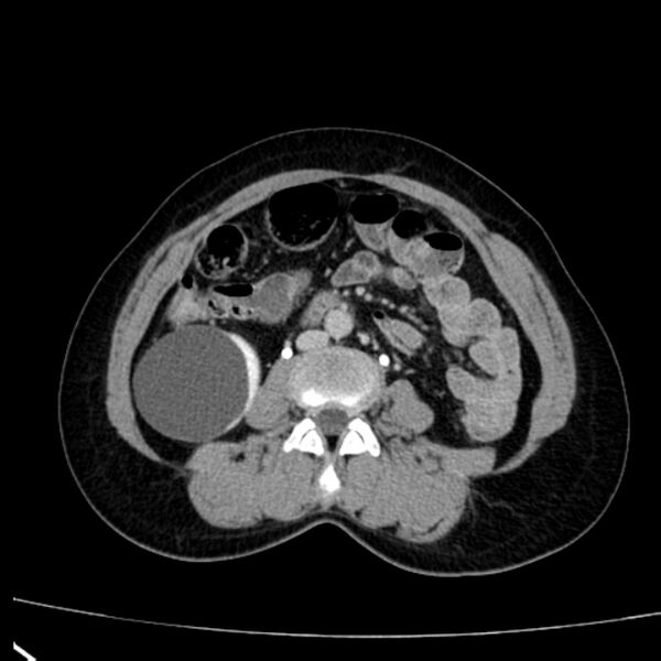 File:Bosniak renal cyst - type I (Radiopaedia 27479-27675 D 29).jpg