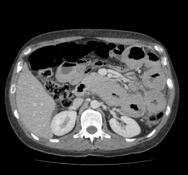 File:Bowel lymphoma complicated by bleeding after therapy (Radiopaedia 55601-62107 A 31).jpg
