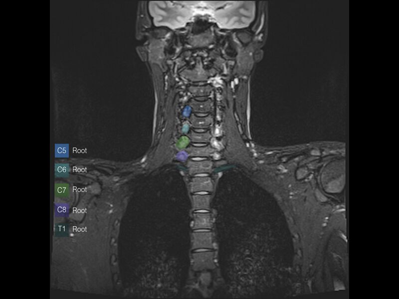 File:Brachial plexus anatomy (Radiopaedia 64414-73226 Coronal STIR 1).jpeg