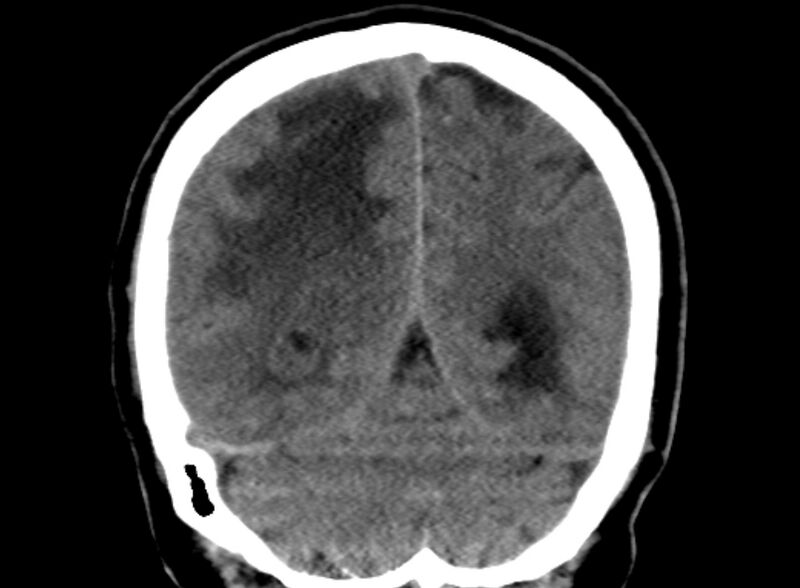 File:Brain abscess complicated by intraventricular rupture and ventriculitis (Radiopaedia 82434-96575 Coronal non-contrast 22).jpg