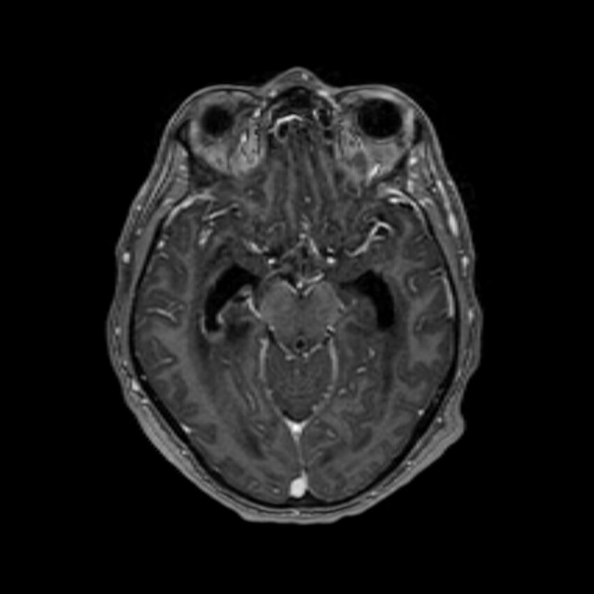Brain abscess complicated by intraventricular rupture and ventriculitis (Radiopaedia 82434-96577 Axial T1 C+ 25).jpg