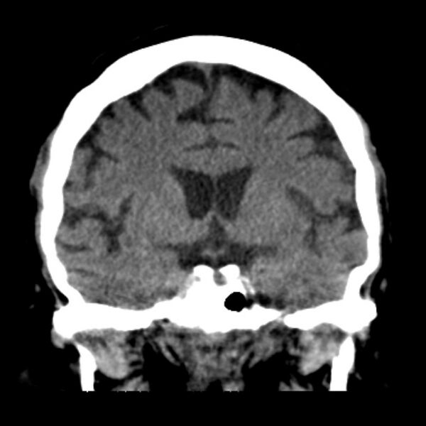 File:Brain cortical laminar necrosis (Radiopaedia 25822-25971 C 24).jpg