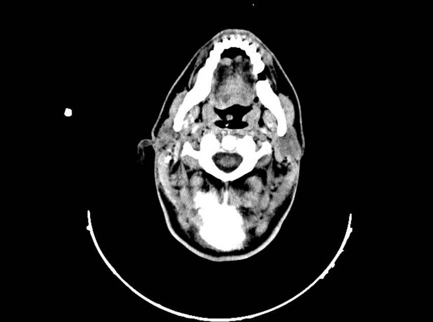 Brain injury by firearm projectile (Radiopaedia 82068-96088 A 52).jpg