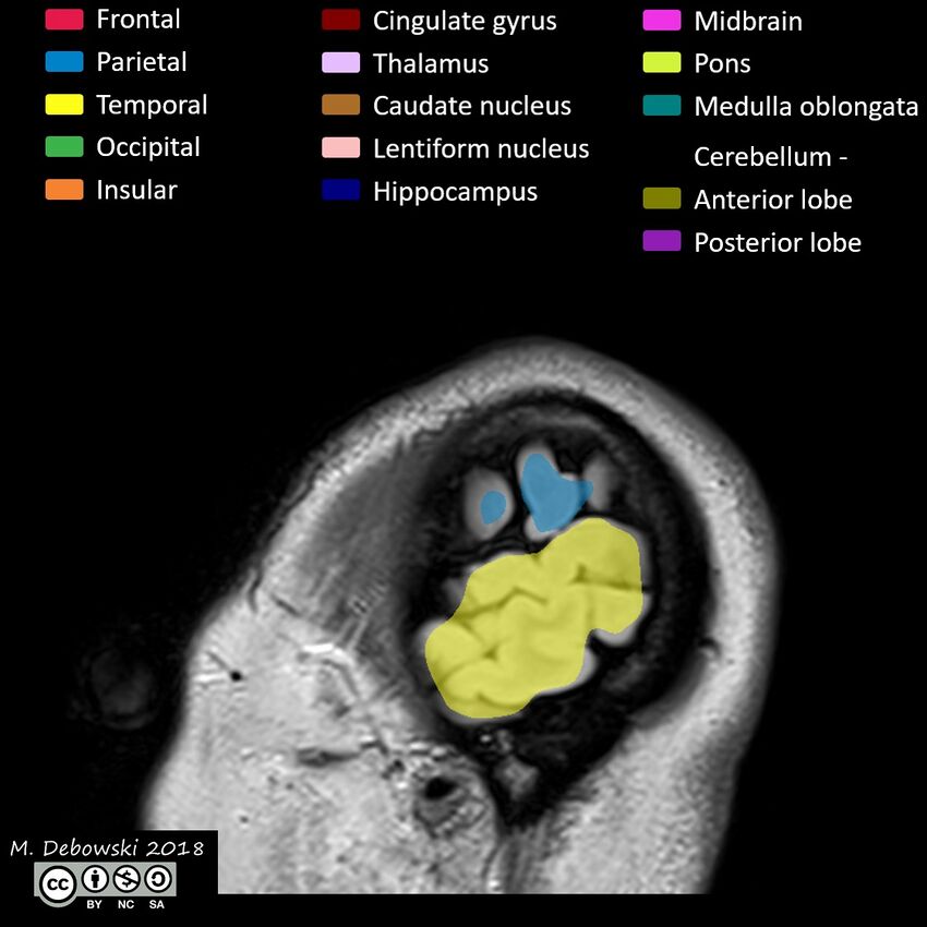 Brain lobes - annotated MRI (Radiopaedia 61691-69700 Sagittal 78).JPG
