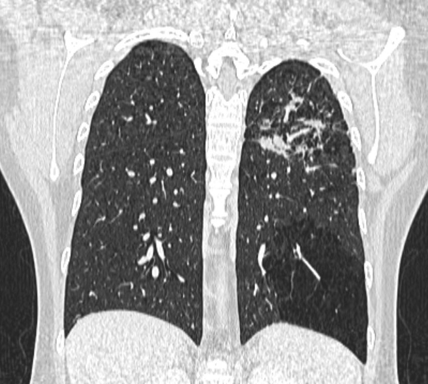 Bronchial atresia (Radiopaedia 50007-55297 Coronal lung window 83).jpg