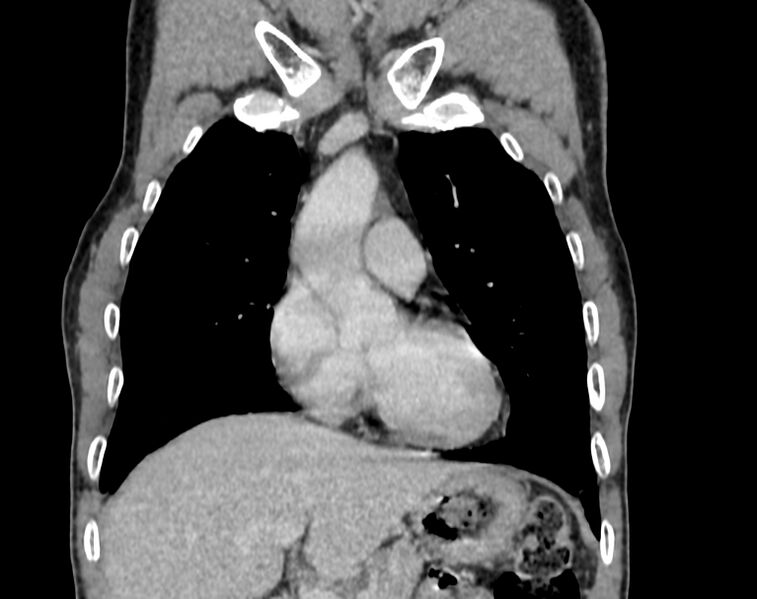 File:Bronchogenic carcinoma with superior vena cava syndrome (Radiopaedia 36497-38054 Coronal C+ delayed 2).jpg