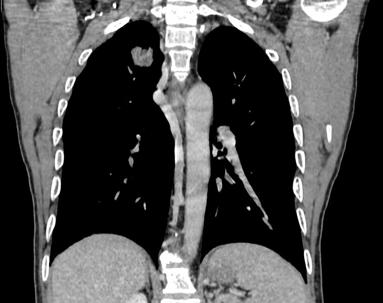 File:Bronchogenic carcinoma with superior vena cava syndrome (Radiopaedia 36497-38054 Coronal C+ delayed 74).jpg