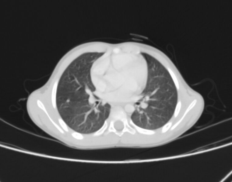 File:Bronchus suis (Radiopaedia 68131-77620 Axial lung window 46).jpg