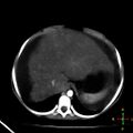 Budd-Chiari syndrome (Radiopaedia 23072-23103 C+ arterial phase 3).jpg