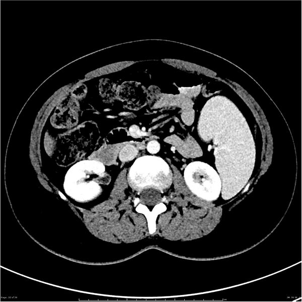 File:Budd-Chiari syndrome (Radiopaedia 27929-28177 Axial liver window 32).JPG