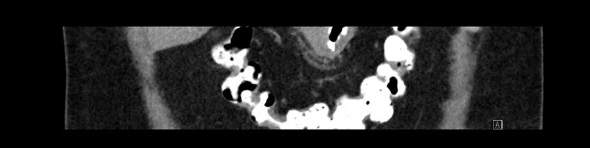Buried bumper syndrome - gastrostomy tube (Radiopaedia 63843-72575 Coronal Inject 27).jpg