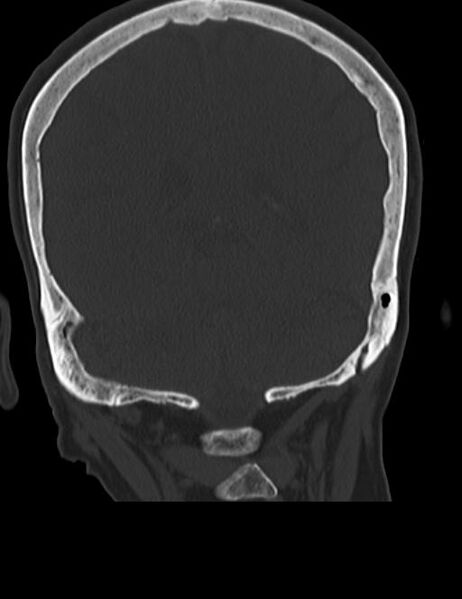 File:Burnt-out meningioma (Radiopaedia 51557-57337 Coronal bone window 38).jpg