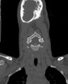 Butterfly vertebra (Radiopaedia 77903-90209 Coronal bone window 2).jpg