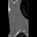 C5 facet fracture (Radiopaedia 58374-65499 Sagittal bone window 11).jpg
