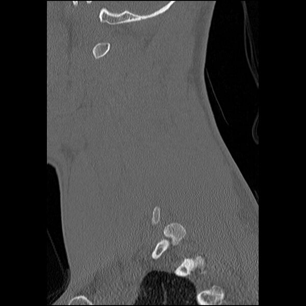 File:C5 facet fracture (Radiopaedia 58374-65499 Sagittal bone window 53).jpg