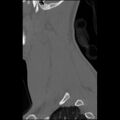 C5 facet fracture (Radiopaedia 58374-65499 Sagittal bone window 59).jpg
