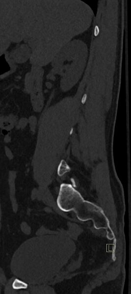 File:Calcaneal fractures with associated L2 burst fracture (Radiopaedia 71671-82493 Sagittal bone window 67).jpg