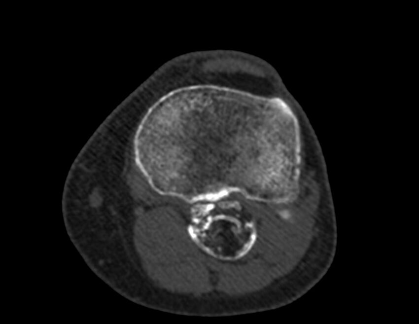 Calcified hematoma - popliteal fossa (Radiopaedia 63938-72763 Axial bone window 50).jpg