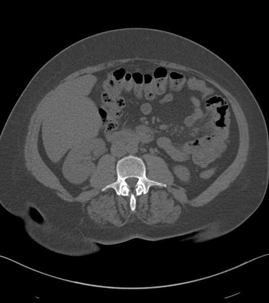 File:Calcified hepatic hydatid cyst (Radiopaedia 81127-94738 Axial non-contrast 50).jpg