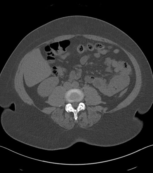 File:Calcified hepatic hydatid cyst (Radiopaedia 81127-94738 Axial non-contrast 57).jpg