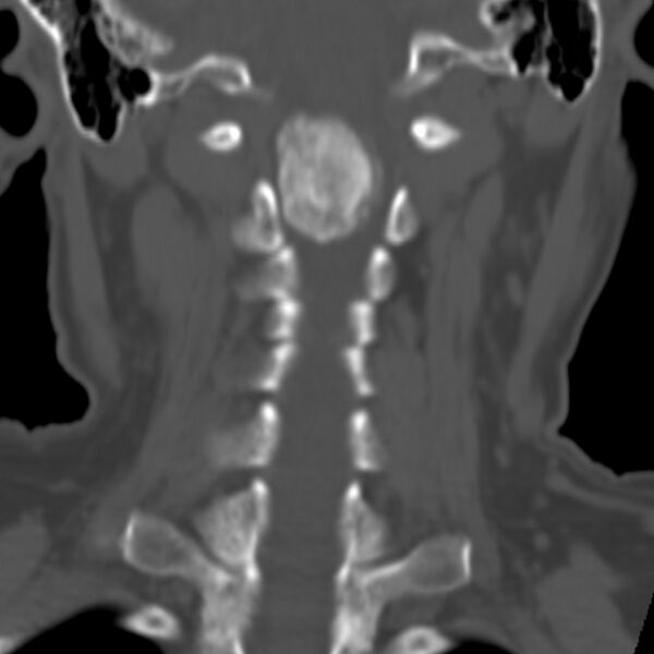 File:Calcified meningioma - cervical canal (Radiopaedia 70136-80171 Coronal bone window 18).jpg