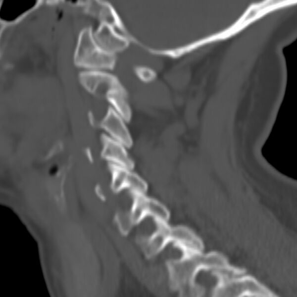 File:Calcified meningioma - cervical canal (Radiopaedia 70136-80171 Sagittal bone window 4).jpg