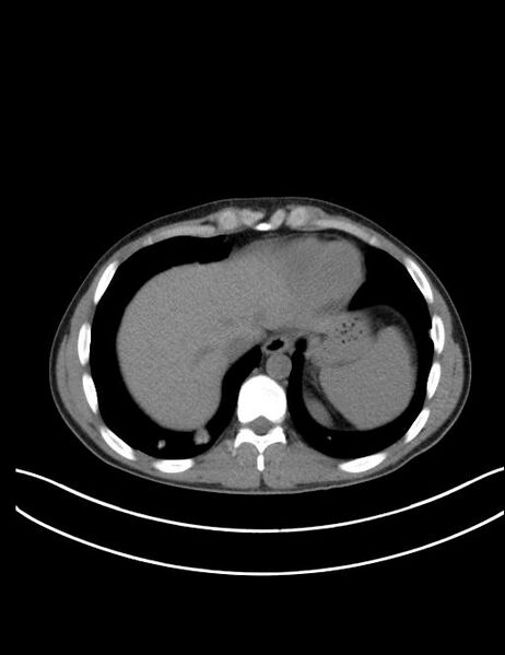 File:Calcifying pulmonary metastases (Radiopaedia 33359-34396 Axial non-contrast 25).jpg