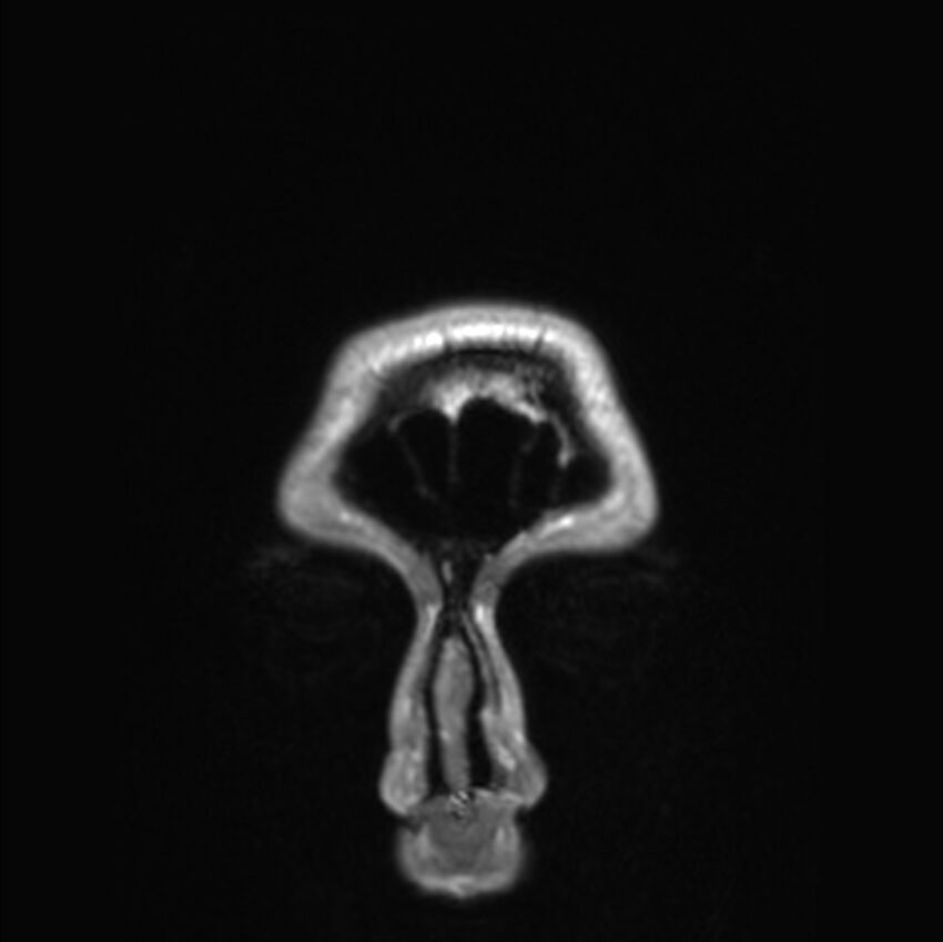 Callosal dysgenesis with interhemispheric cyst (Radiopaedia 53355-59335 Coronal T1 190).jpg