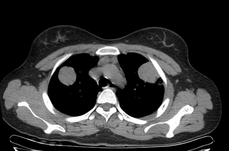 File:Cannonball metastases - uterine choriocarcinoma (Radiopaedia 70137-80173 Axial non-contrast 21).jpg