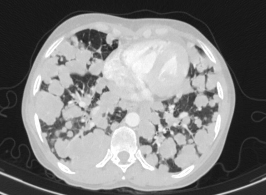 Cannonball metastases from breast cancer (Radiopaedia 91024-108569 Axial lung window 72).jpg
