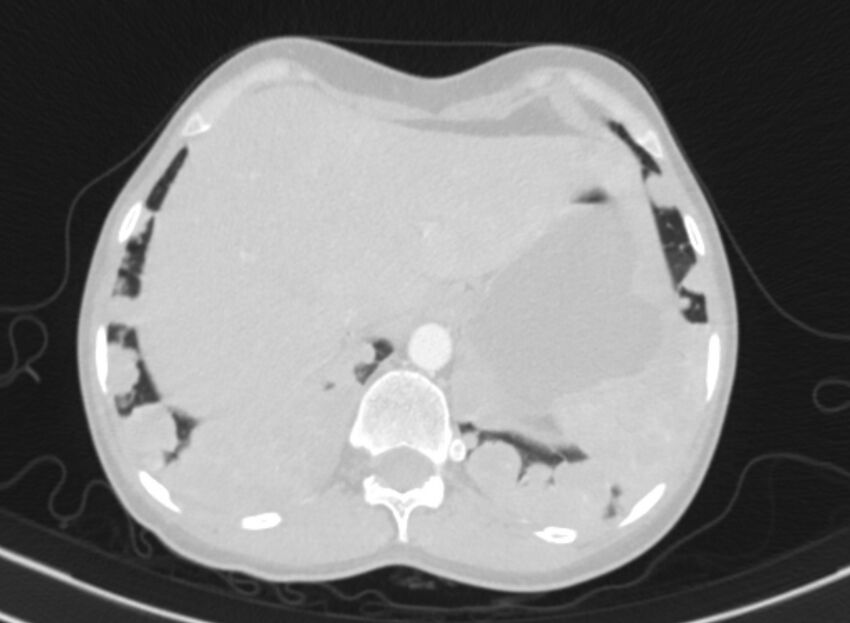 Cannonball metastases from breast cancer (Radiopaedia 91024-108569 Axial lung window 93).jpg