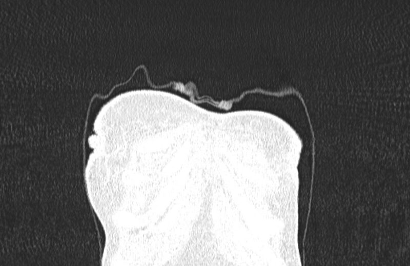 File:Cannonball metastases from breast cancer (Radiopaedia 91024-108569 Coronal lung window 7).jpg