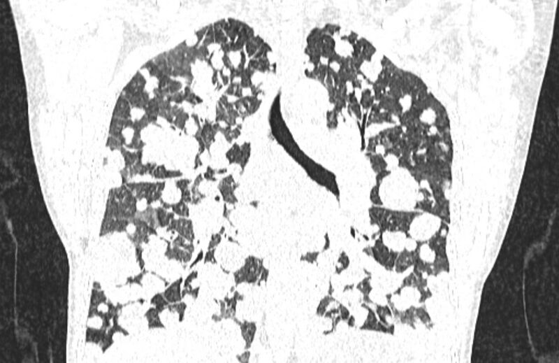 File:Cannonball metastases from breast cancer (Radiopaedia 91024-108569 Coronal lung window 87).jpg