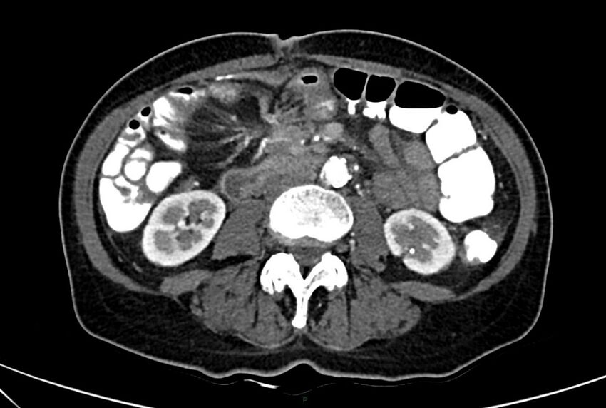 Carcinoid mesenteric tumor complicated by chylous ascites (Radiopaedia 76312-88926 A 37).jpg
