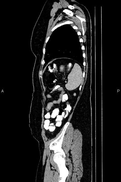 File:Carcinoma of uterine cervix (Radiopaedia 85861-101700 D 73).jpg