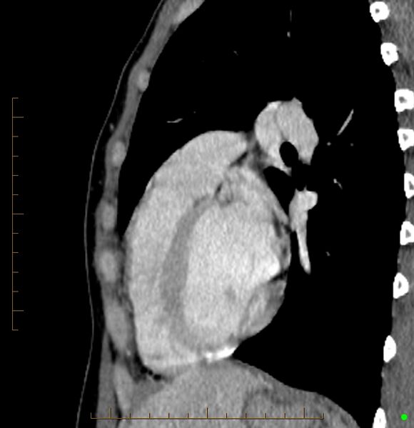 File:Cardiac paraganglioma (Radiopaedia 76345-88005 C 33).jpg