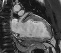 Cardiac sarcoidosis (Radiopaedia 39811-42243 B 25).jpg