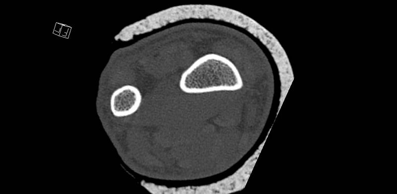 File:Carpal fractures (smart watch impaction) (Radiopaedia 55844-62430 Axial bone window 3).jpg