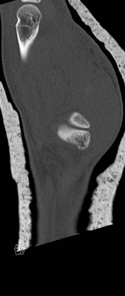 File:Carpal fractures (smart watch impaction) (Radiopaedia 55844-62430 Sagittal bone window 38).jpg