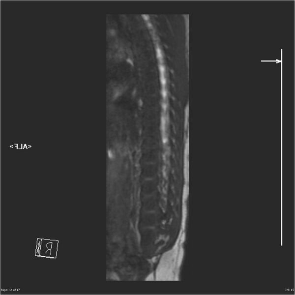 File:Caudal regression syndrome (Radiopaedia 23610-23727 Sagittal CISS 14).jpg