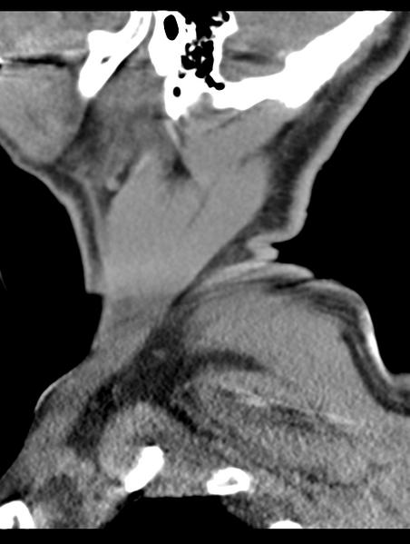 File:Cavernoma of cervical cord (Radiopaedia 50838-56346 B 4).png