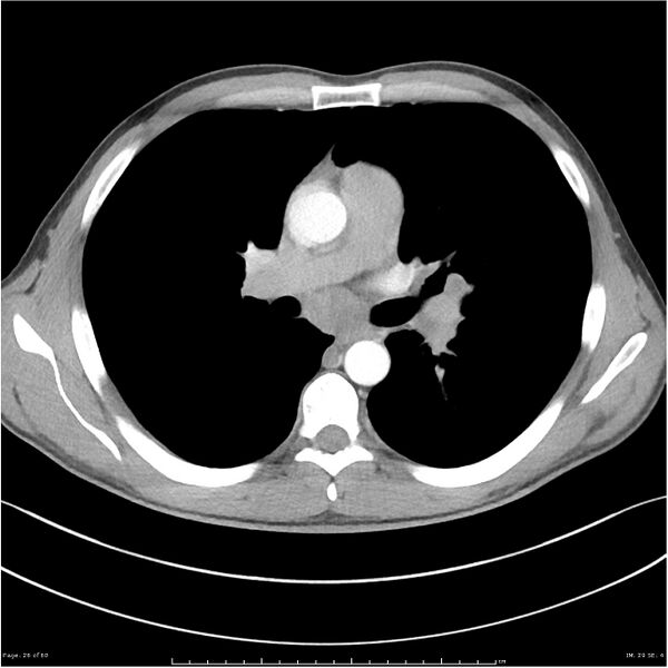 File:Cavitating lung cancer (Radiopaedia 25796-25945 C+ arterial phase 26).jpg
