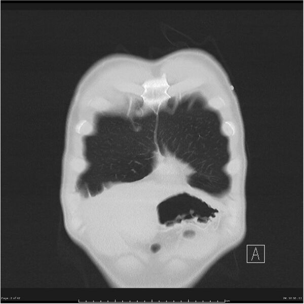 File:Cavitating lung cancer (Radiopaedia 25796-25945 lung window 2).jpg