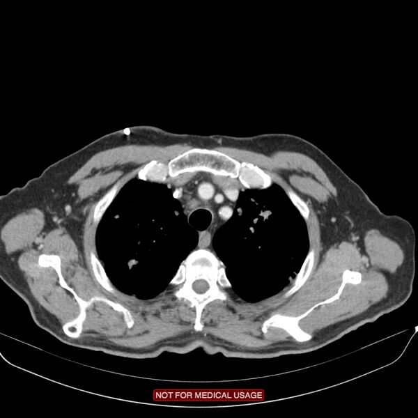 File:Cavitating pulmonary metastases (Radiopaedia 24920-25184 B 3).jpg
