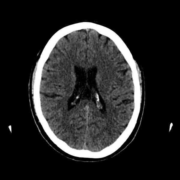 File:Central nervous system Langerhans cell histiocytosis (Radiopaedia 65728-74878 Axial non-contrast 32).jpg