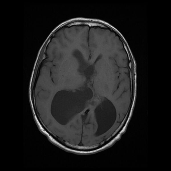 File:Central neurocytoma (Radiopaedia 67618-77021 Axial T1 13).jpg