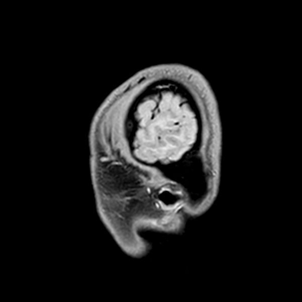File:Central neurocytoma (Radiopaedia 79320-92380 Sagittal T1 241).jpg